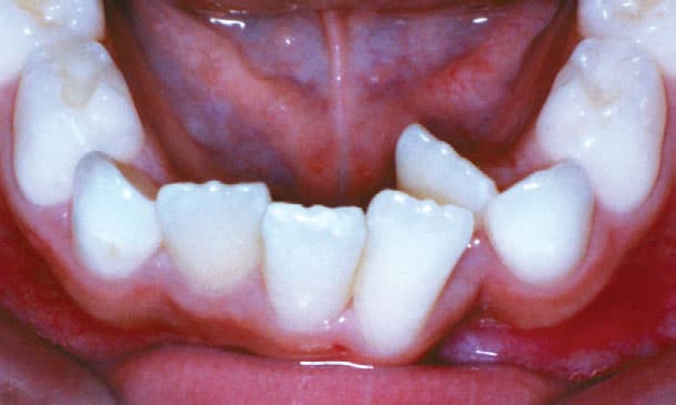 Apiñamiento Ortodoncia Gather en Holly Springs, NC