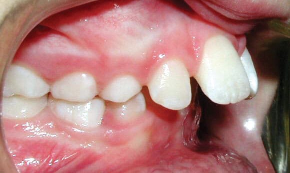 Ortodoncia de protrusión Gather en Holly Springs, NC