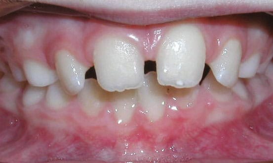 Espaciamiento Ortodoncia Gather en Holly Springs, NC