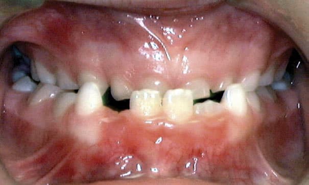 Submordida Ortodoncia Gather en Holly Springs, NC