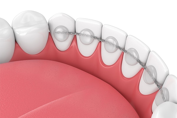Retenedores fijos Gather Orthodontics en Holly Springs, NC